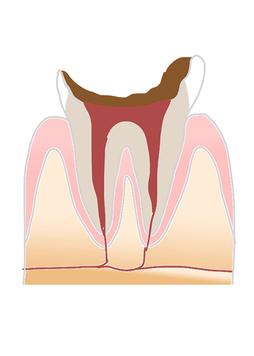 歯の根(歯質)が失われた歯