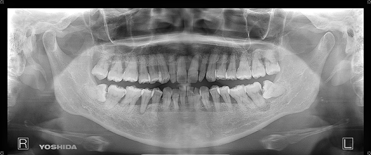 歯周病と全身疾患との関わり