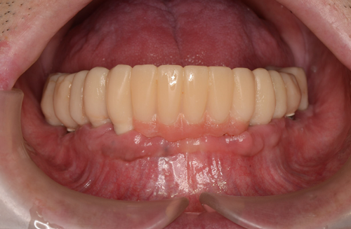 症例CASE3-2 仮歯